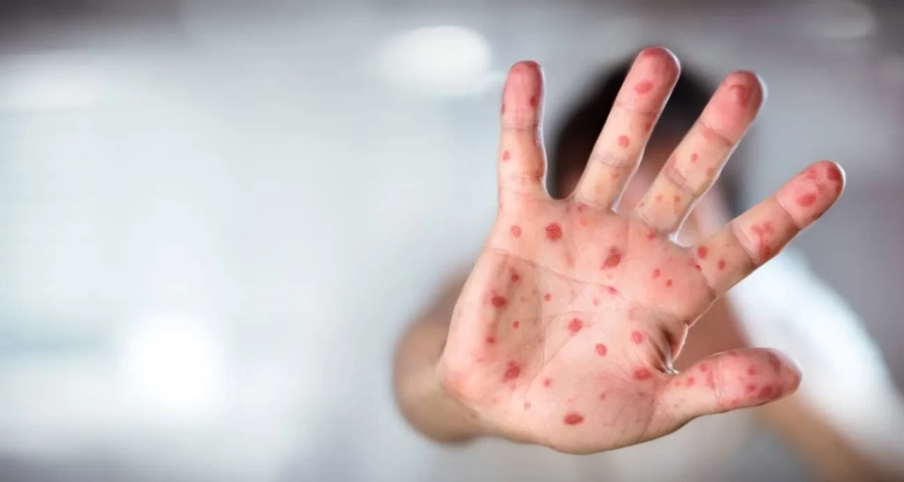 ABD’de kızamık vakaları 33 yılın zirvesinde