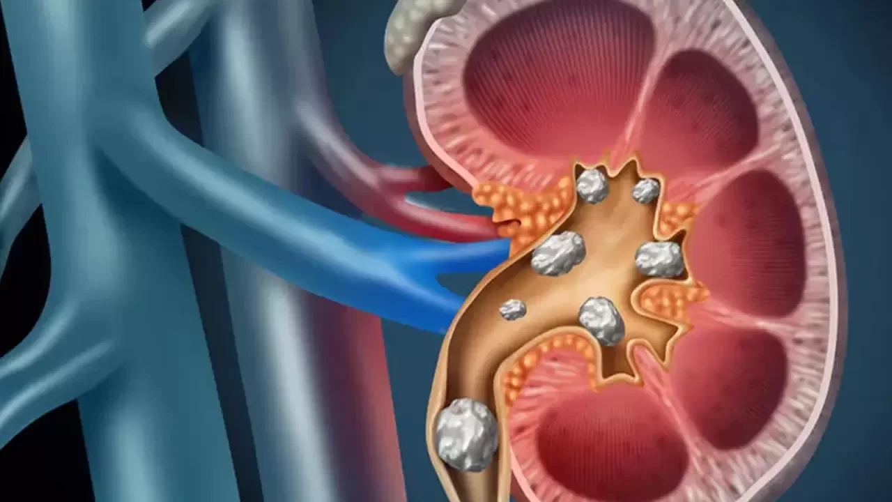 Uzmanından böbrek taşlarına karşı günde "2 litre" uyarısı