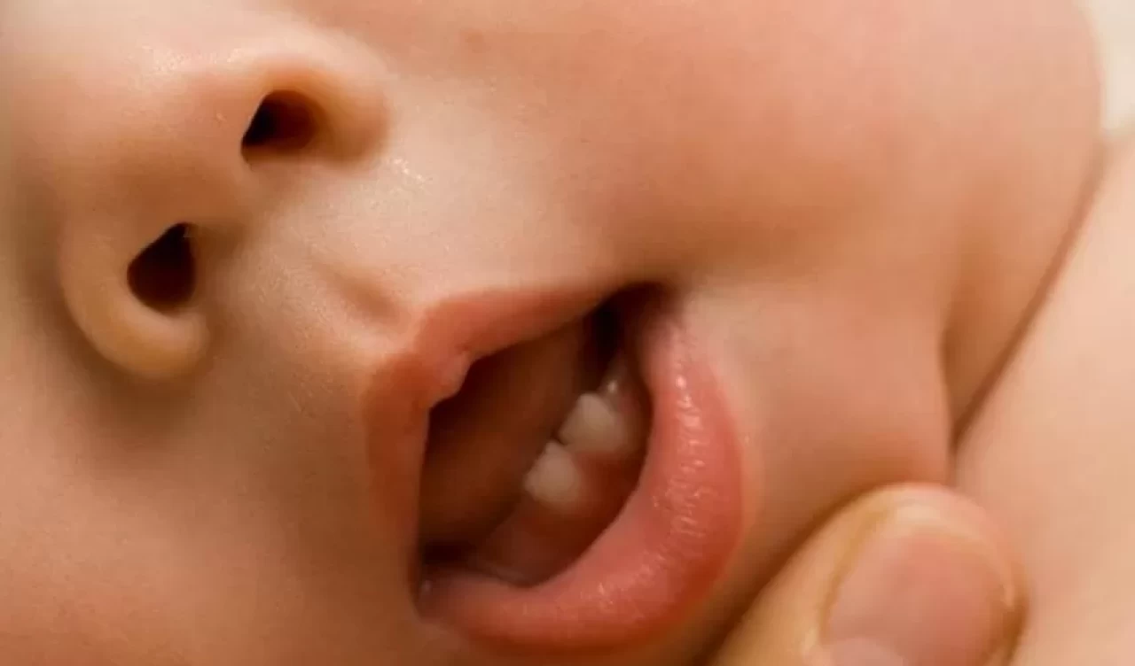 Bebeklerde diş çıkarma ağrısı ve kaşıntısına karşı etkili çözümler