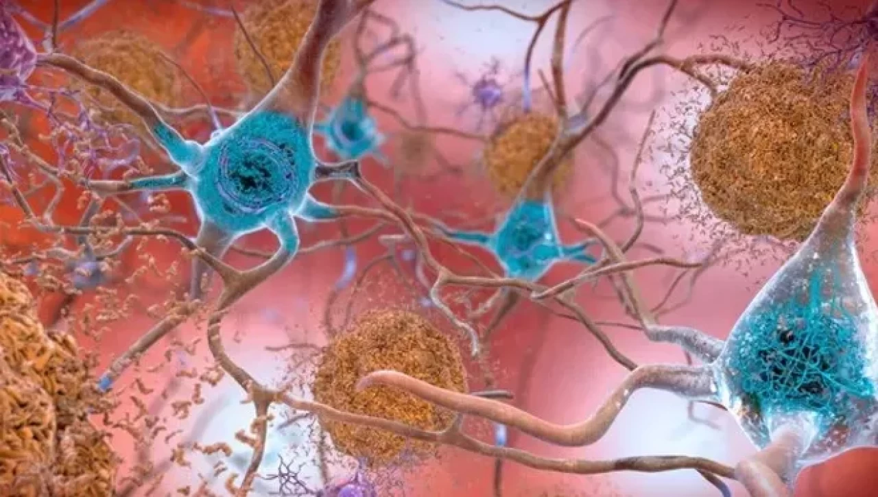 Alzheimer tedavisinde yeni umut: 2 kanser ilacı çare olabilir