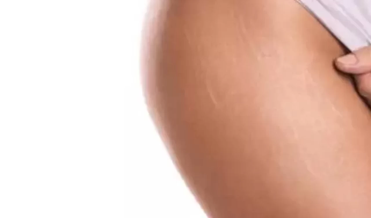 Vücut çatlakları için hemen uygulayabileceğiniz basit çözümler