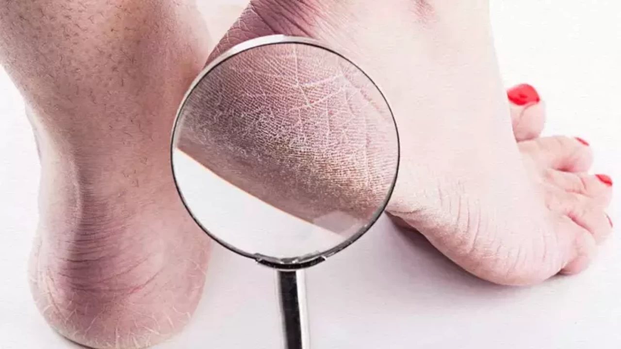 Topuk çatlakları: Neden olur ve nasıl önlenir?