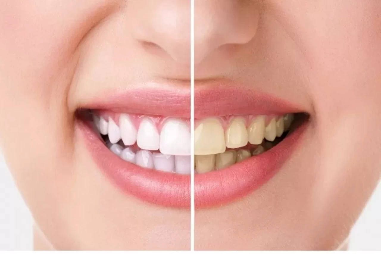 Doğal diş beyazlatma! Damla sakızıyla parıl parıl gülüşler
