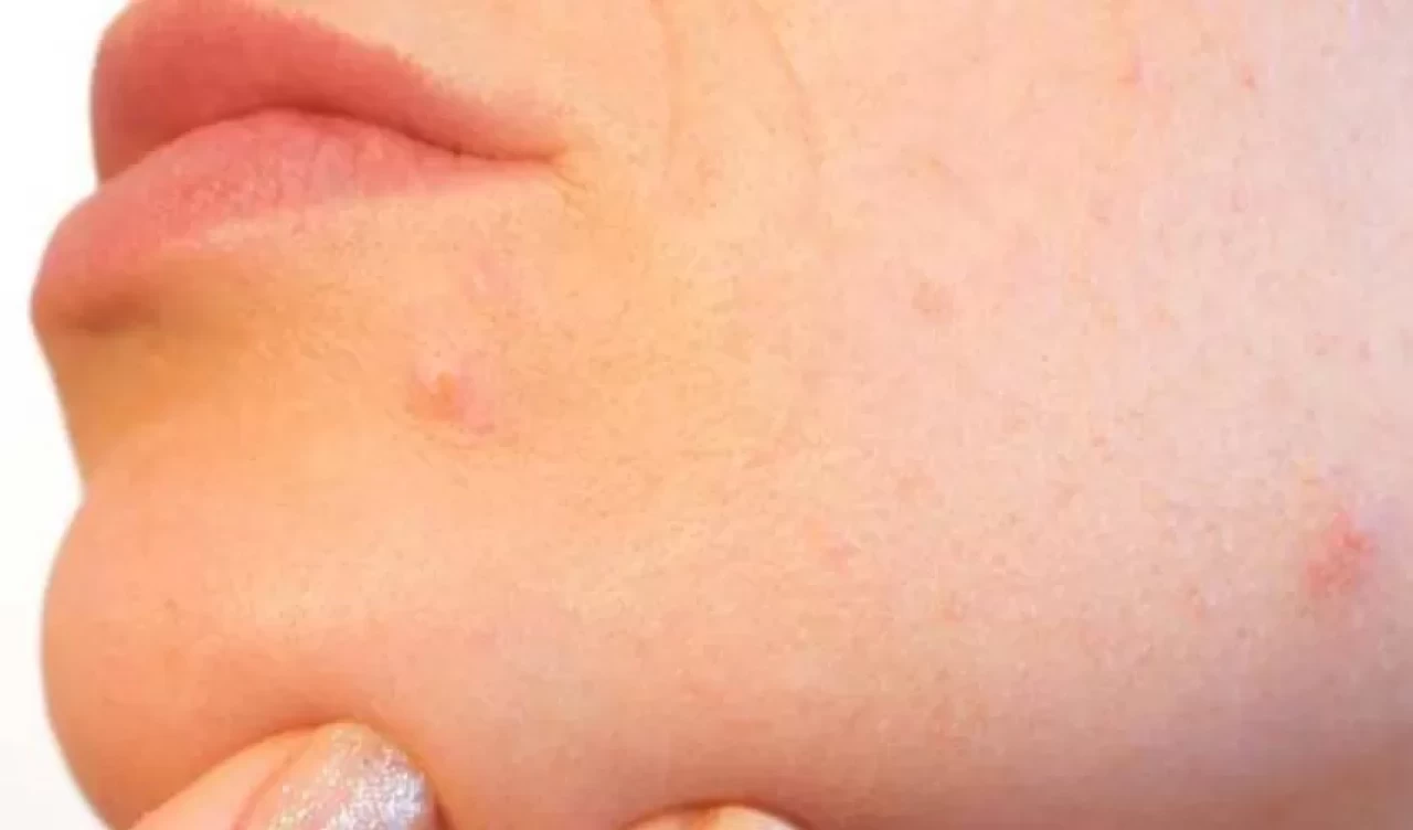 Hamilelikte cilt sorunlarıyla başa çıkmanın 5 doğal yolu