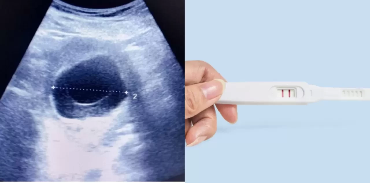 Tüp Bebek Sürecinde Yumurtalık ve Rahim Hazırlığı: Nelere Dikkat Edilmeli?