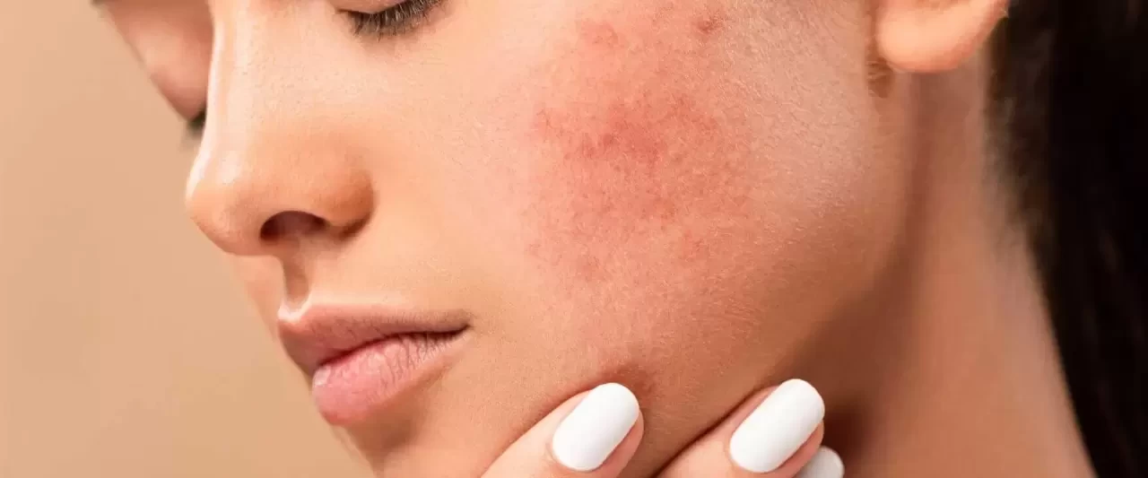 Cilt Lekelerine Karşı En Yeni Tedavi Yöntemleri