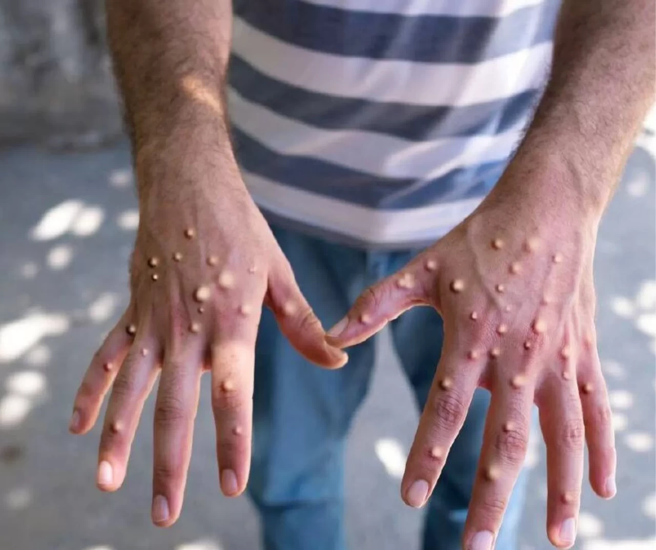 Afrika'da M çiçeği virüsü alarmı!