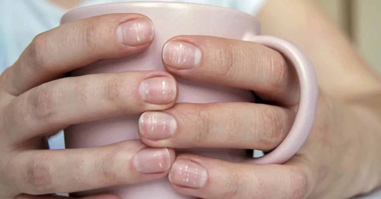 Tırnaklardaki beyaz çizgilerin sebebi ne?