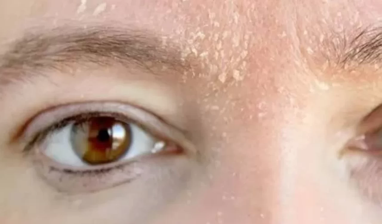 Pul pul kuruluk ve yağlanma! Sonbaharda cilt nasıl dengelenir?