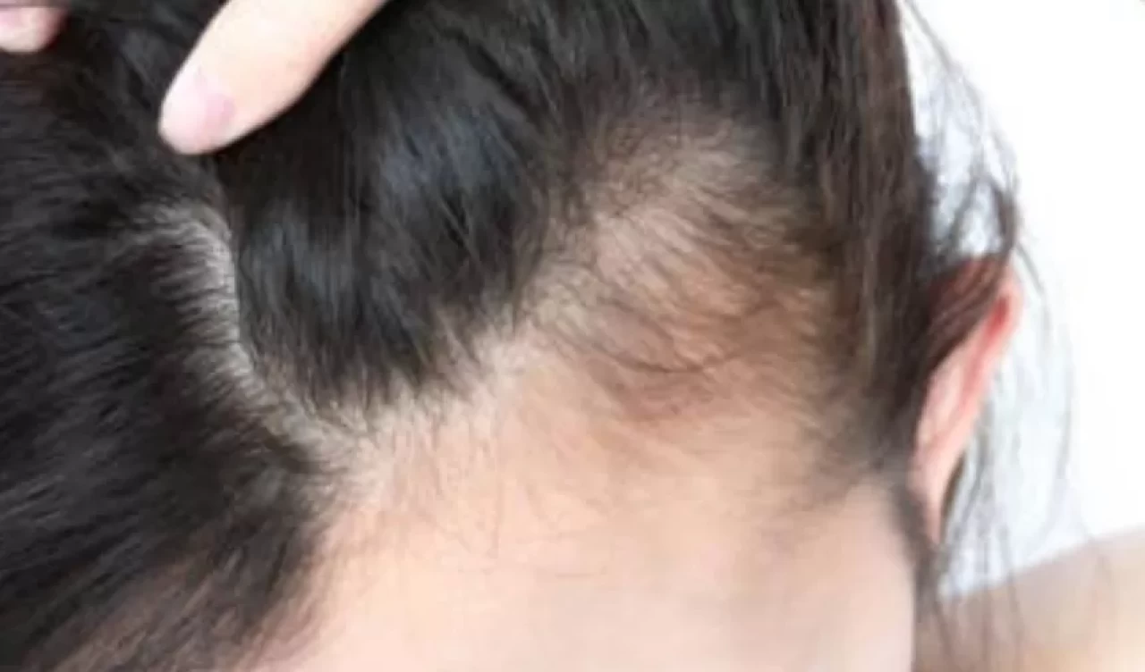 Ölü saç kökleri saç dökülmesinin en önemli sebebi