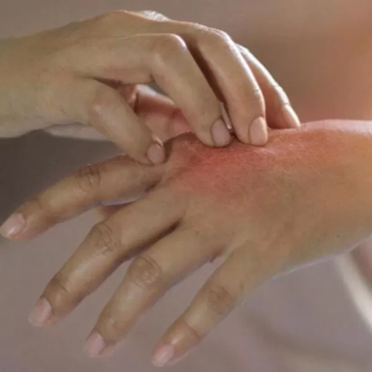 Elinizdeki kaşıntılı, kızarık egzamadan bıkmadınız mı? İlaç değil, İbn-i Sina dokunuşu!