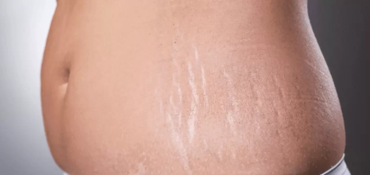 Hamilelikte Cilt Çatlaklarını Önlemenin Püf Noktaları