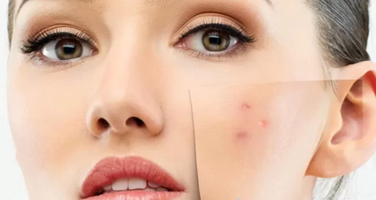 Akne lekelerine karşı en etkili gece rutini