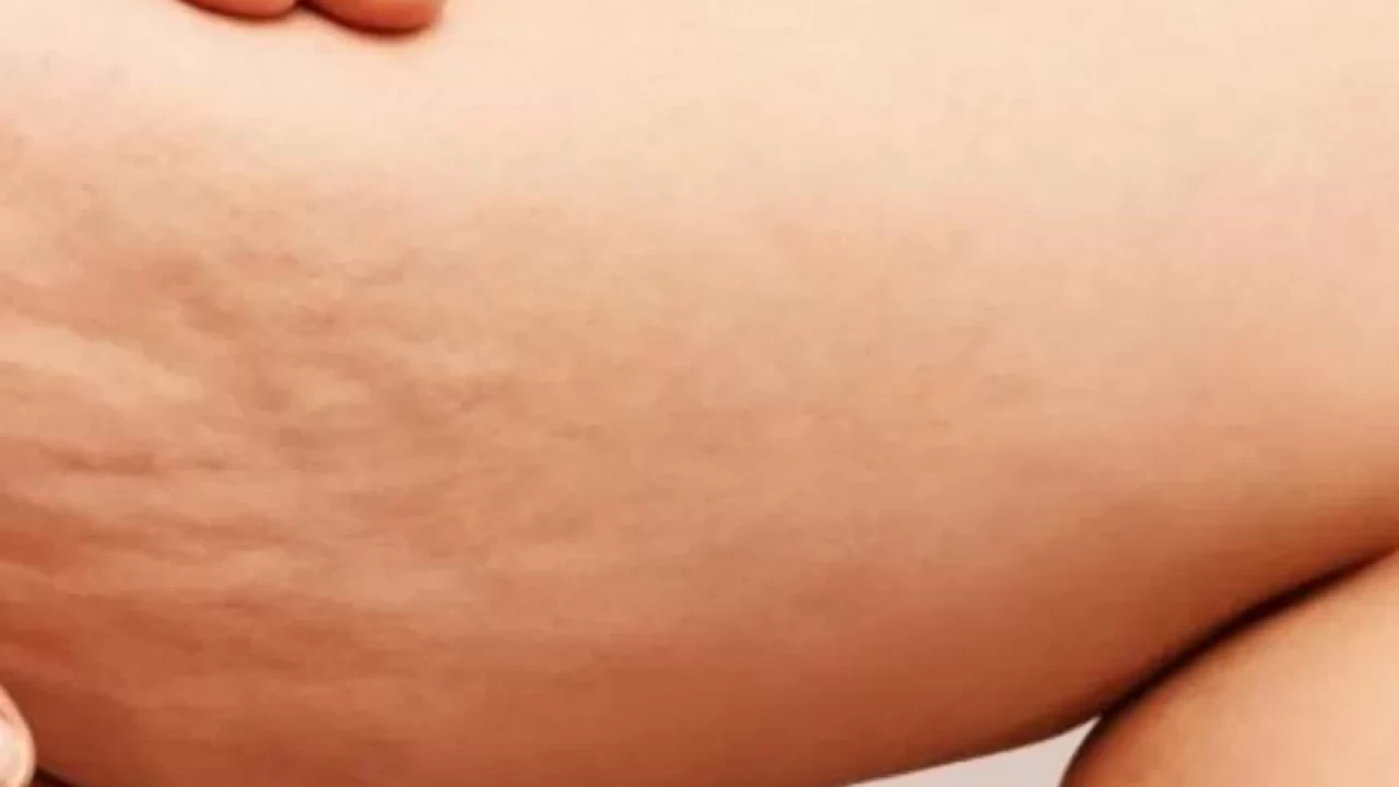 Kilo verince selülit azalır mı?