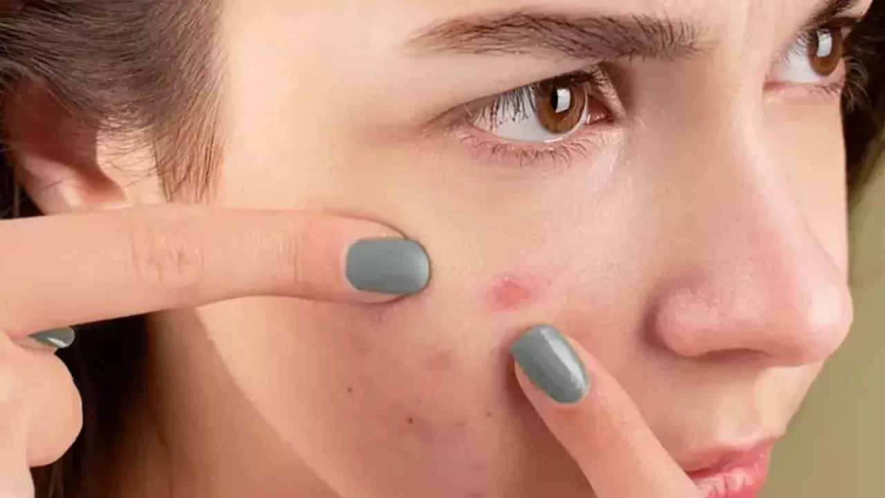 Aynı noktada ısrar eden sivilceler tesadüf değil! İşte gerçek nedeni buymuş