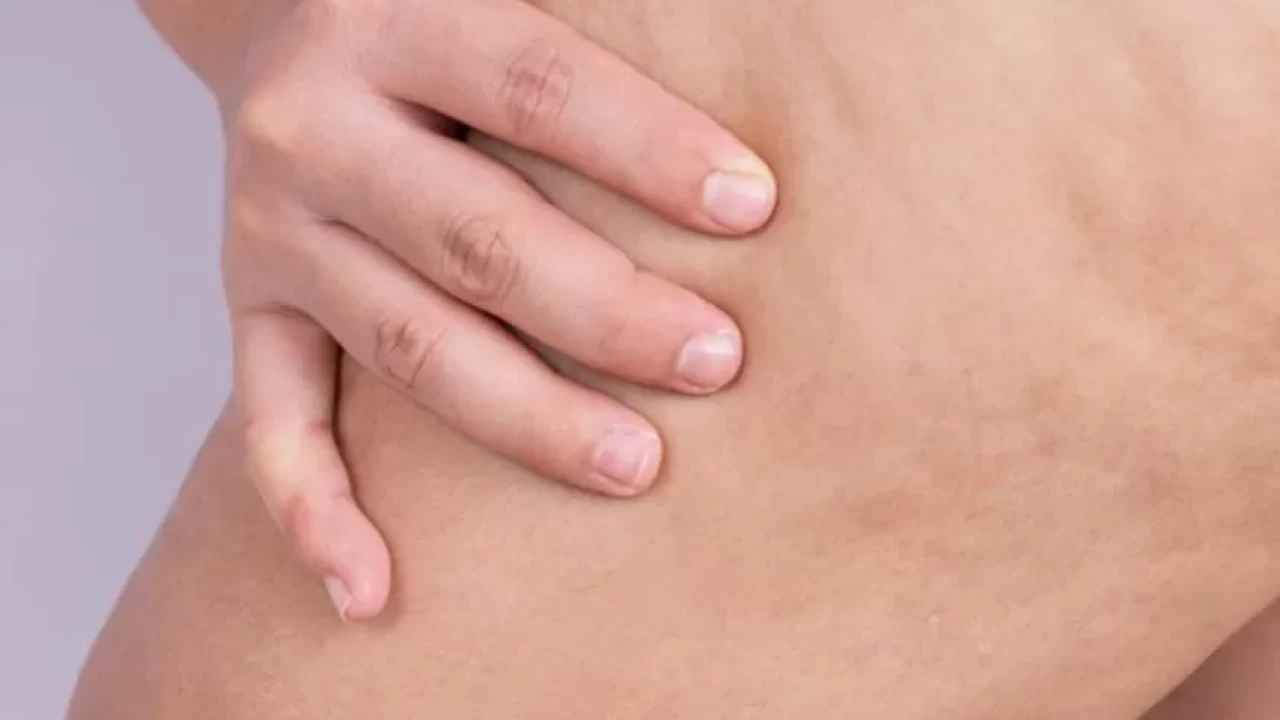 Selülit tedavisinde en çok tercih edilen 3 yöntem