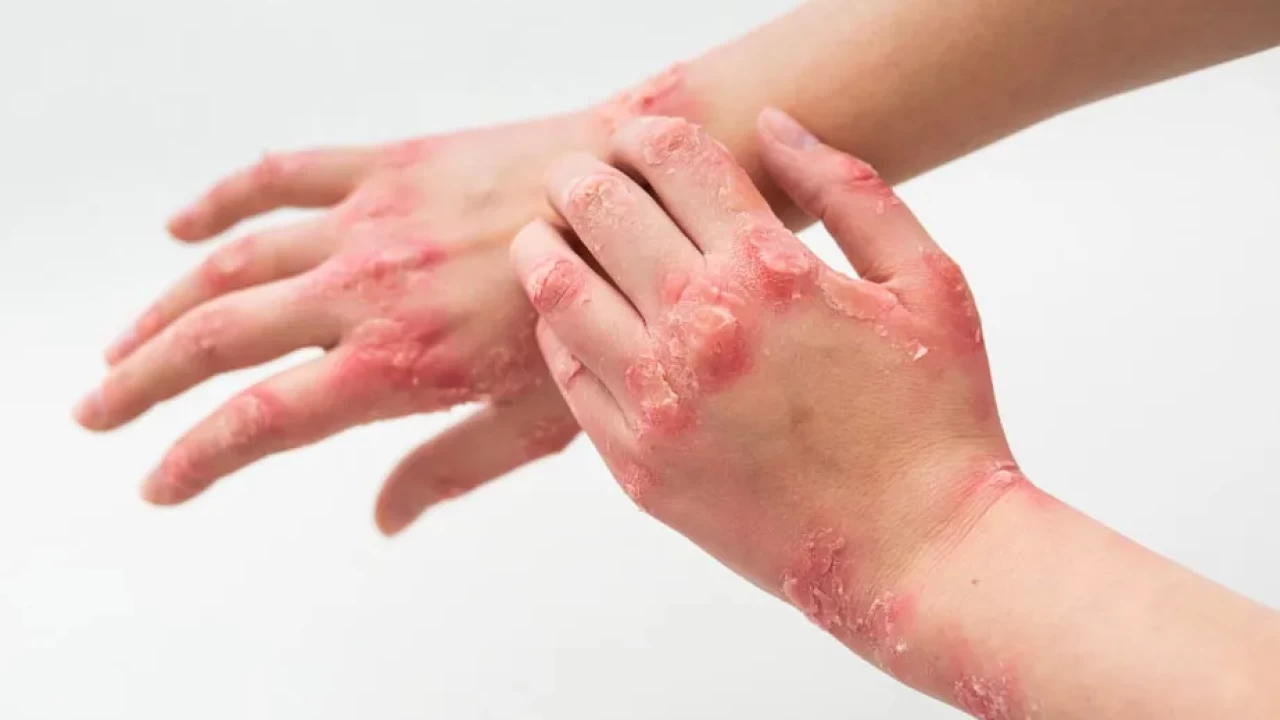 Egzama Sanıp Geçmeyin! Bu Belirti Vücudunuzun Yardım Çığlığı Olabilir