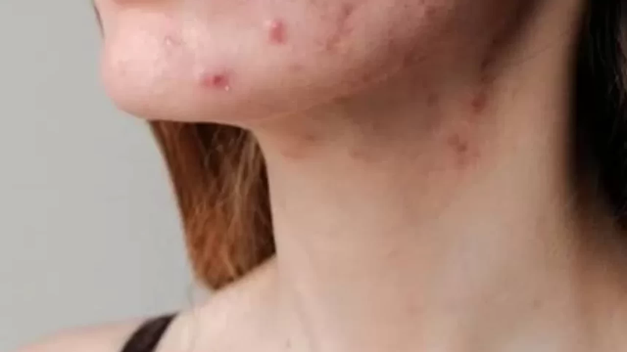 Yoğurt maskesi ile sivilce ve akneden kurtulun