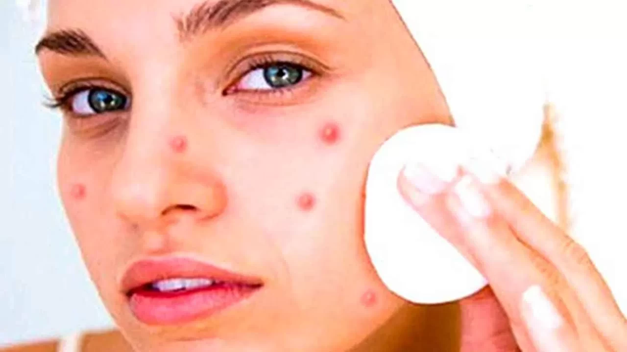 Sivilce izleri tarihe karışıyor! O meşhur ürünler yerine evde ne kullanmalısınız?