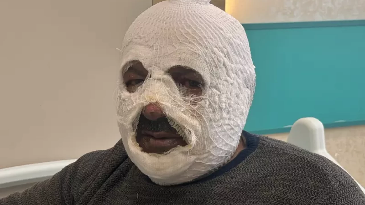 Kalorifer kazanı faciası: Benzin döktü, alevler içinde kaldı