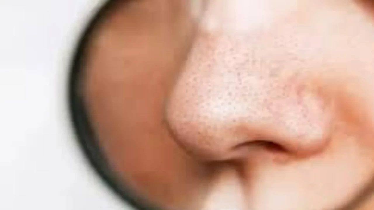 Siyah nokta temizliğinde çığır açan doğal yöntem! Herkes bu maskeyi konuşuyor