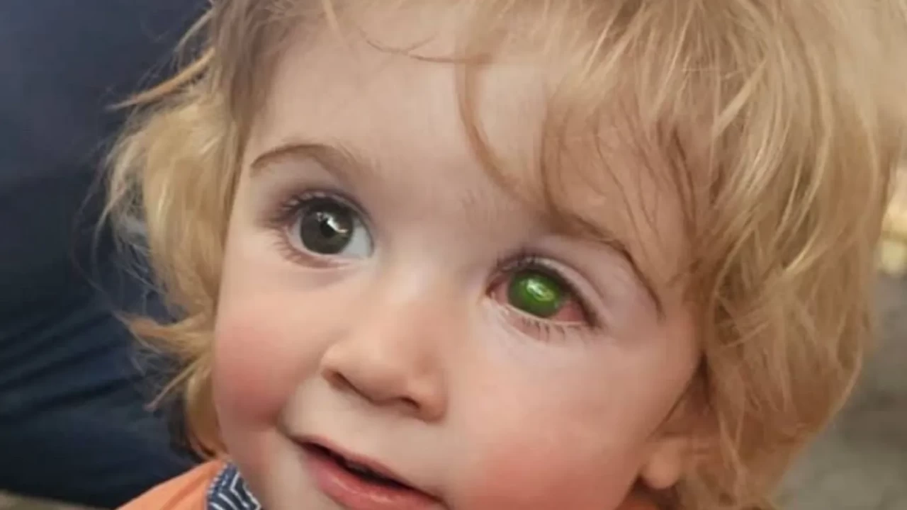 Bir öpücük hayatını kararttı! 2 yaşındaki Juwan'ın gözündeki görme kaybı dünyayı ayağa kaldırdı