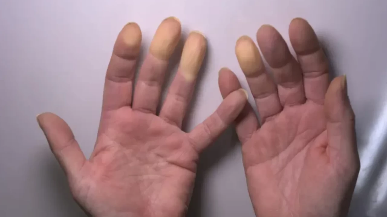 Raynaud hastalığı belirtileri nelerdir?