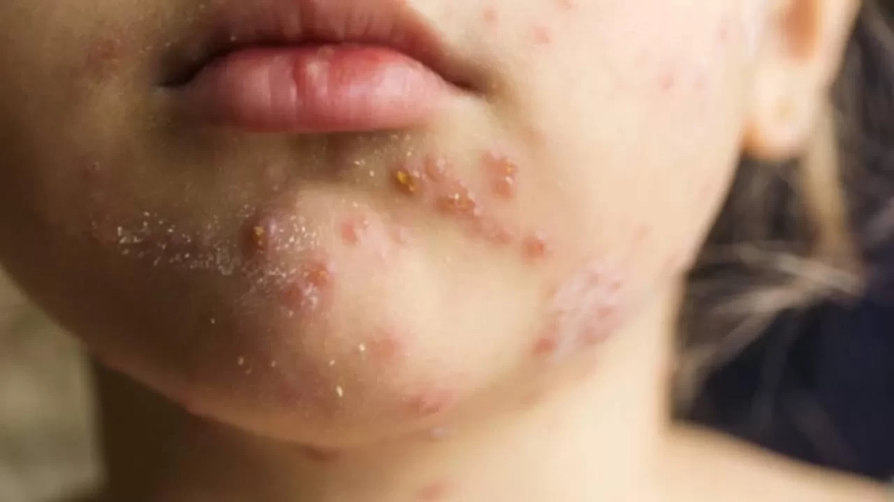 Uzmanından  kızamık  uyarısı: Aşılar eksiksiz yapılmalı