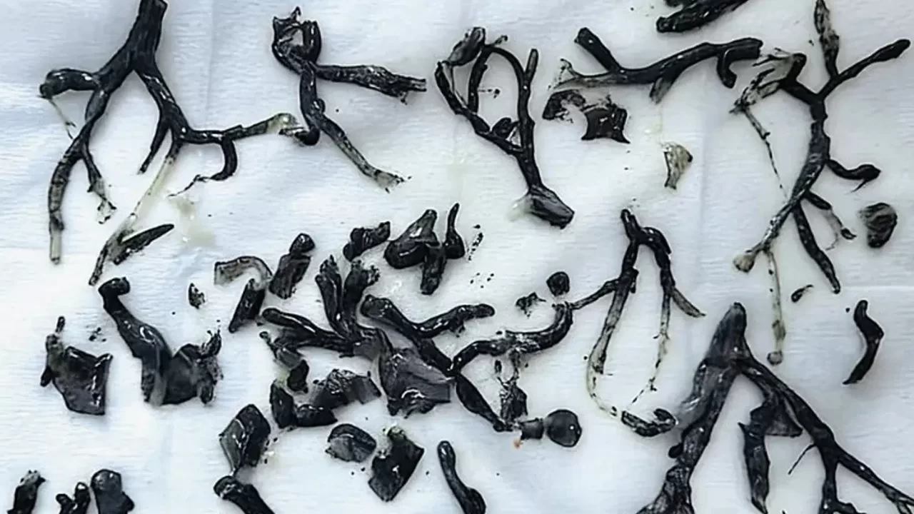 Nefes darlığıyla hastaneye gitti, doktorlar gördüklerine inanamadı