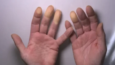 Raynaud hastalığı belirtileri nelerdir?
