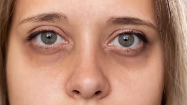 Göz altı morlukları neden olur? Oluşmasına yol açan etkenler