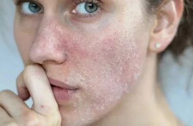 Sonbaharda Cilt Alarmı: Aynı Anda Hem Kuruyor Hem Yağlanıyor!