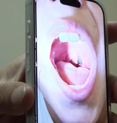 Çocuğun boğazından canlı sülük çıktı