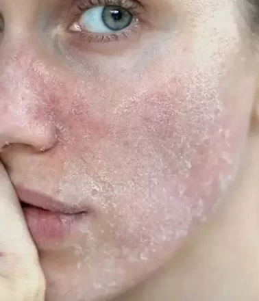 Sonbaharda Cilt Alarmı: Aynı Anda Hem Kuruyor Hem Yağlanıyor!