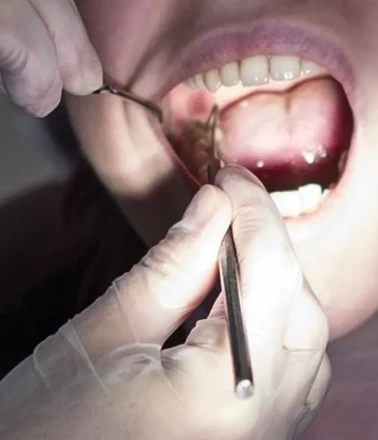 Löseminin ilk belirtilerinden biri ağızda başlıyor: