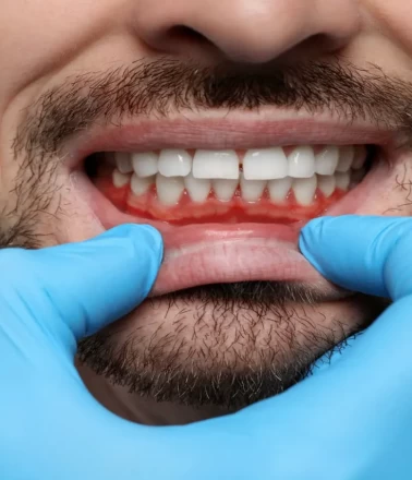 Diş eti morarması nasıl geçer?