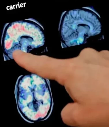 Alzheimer'ın sırrı derin uykuda mı?