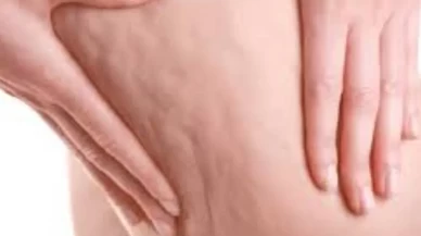 Kadınların yüzde 90'ında görülüyor! İşte selülitin gizli nedenleri