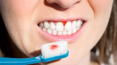 Evde doğal yöntemlerle 3 günde son!