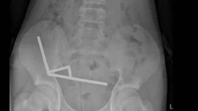 200 tane mıknatıs yuttu!