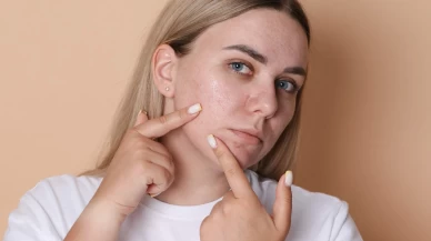 İlaçsız Sivilce İzi Silme Rehberi! Doğanın Gücüyle Pürüzsüz Cilt Etkisi