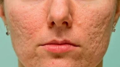 Delik görünümünü yok eden doğal çözüm