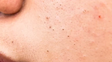 Siyah Noktaları Temizleyen En Etkili Doğal Maskeler! Cildiniz Yeniden Işıl Işıl Olacak