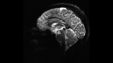 Yapay zeka, epilepsili çocuklarda doktorların gözden kaçırdığı gizli lezyonları buldu