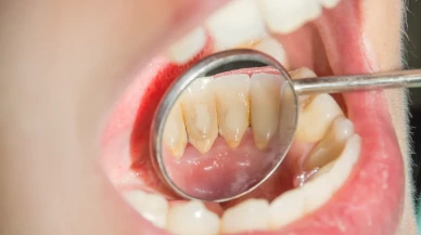 Küçücük diş eti taşları ölümcül riski ortaya çıkarıyor