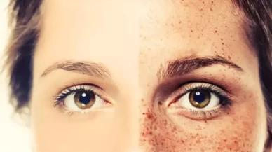 Doğal yöntemlerle çilleri azaltın! En etkili ev yapımı maske tarifi