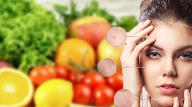 Bu gıdalar akneyi tetikliyor!