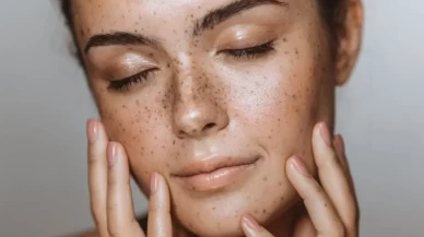 Kış lekelerine karşı ev yapımı losyon