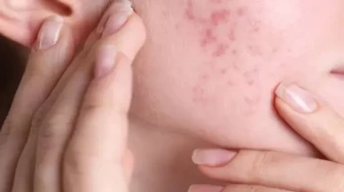 Yağlı ciltler için çay ağacı yağı: Sivilceleri azaltan doğal iksir