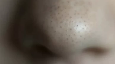 Cildinizdeki siyah noktalardan kurtulmanın doğal yolları neler?